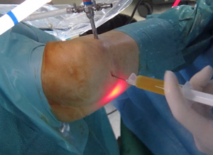 Infiltracion de Plasma Rico en Plaquetas en rodilla tras cirugí­a